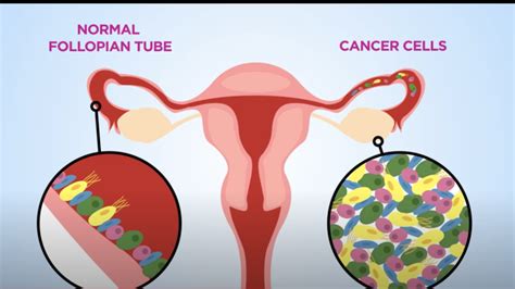 Cancer — Nuffield Department Of Womens And Reproductive Health
