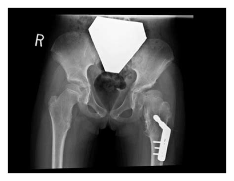 a anteroposterior pelvic radiograph at initial presentation b download high quality