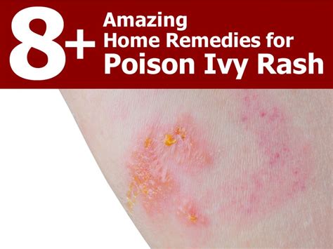 Amazing Natural Treatments For Poison Ivy Rash