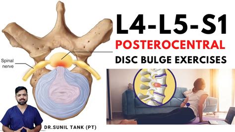 l4 l5 s1 posterocentral disc bulge exercises l4 l5 and l5 s1 central disc bulge treatment in