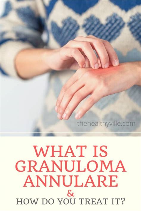 What Is Granuloma Annulare And How Do You Treat It