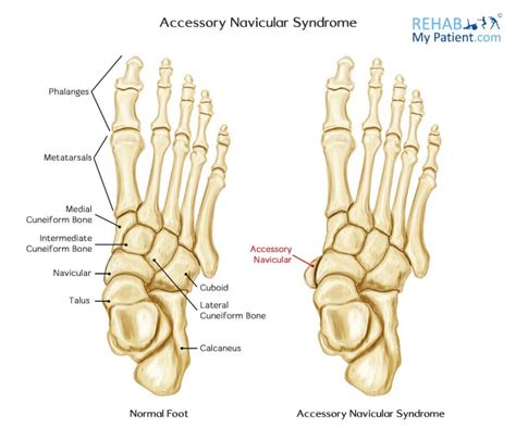 Accessory Navicular Syndrome Rehab My Patient