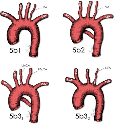 Four Subtypes With 5 Branches Arsa Aberrant Right Subclavian Artery