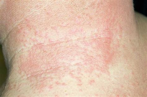 Shingles Rash On The Neck Photograph By Dr P Marazziscience Photo Library