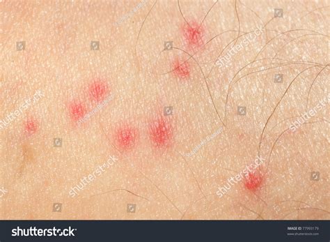 Male Skin Macro Showing Mosquito Bites Stock Photo Edit Now 77993179