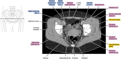 Ct Of The Female Pelvis Radiology Key