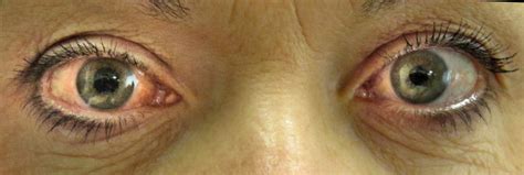Glaukoun to have a cataract, fr. File:Acute angle closure glaucoma.JPG - Wikimedia Commons