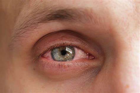 Coronavirus Symptoms Scientists Believe Covid 19 Causes Pink Eye