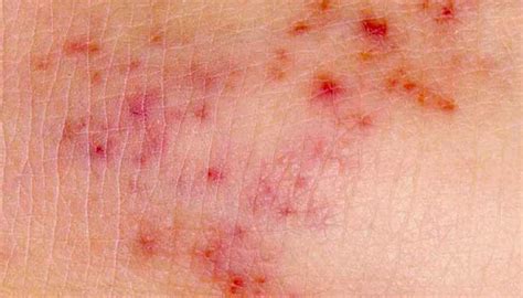 Meningitis Rash Pictures Symptoms And Similar Rashes Medical News