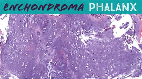 Enchondroma Special Rules For Cartilage Tumors In Phalanx Fingers Toes