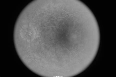 Idiopathic Juxtafoveal Telangiectasis Retina Specialists Of North