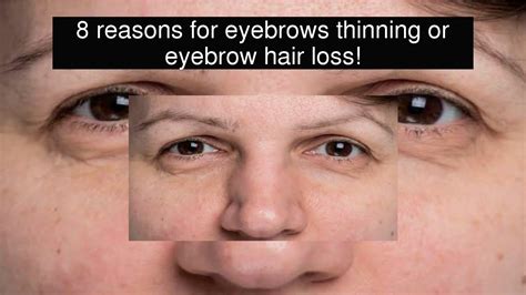 8 Reasons For Eyebrows Thinning Or Eyebrow Hair Loss Youtube