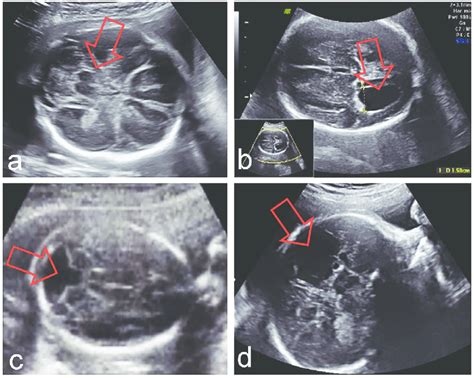 Fetal Brain Abnormalities Ultrasound Hot Sex Picture