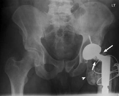 Ceramic Total Hip Replacement With Shattering Of The Ceramic Head