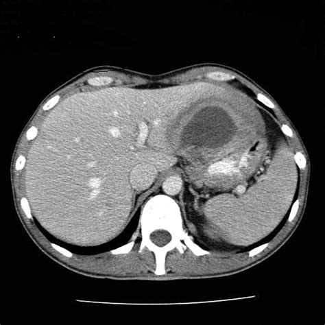 A Missed Case Of Intra Abdominal Sepsis Bmj Case Reports