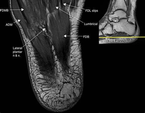It must be placed in the center of the magnet, to obtain homogeneous fat. Normal Magnetic Resonance Imaging Anatomy of the Ankle & Foot - Magnetic Resonance Imaging Clinics