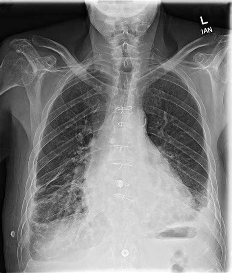 Pa Chest X Ray Demonstrating Cardiomegaly Bilateral Opacities And