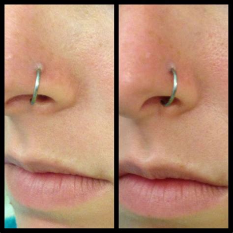 List 92 Pictures Keloid Nose Piercing Healing Process Pictures Full Hd