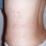 What Do Bed Bug Bites Look Like Pictured Public Health