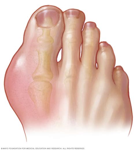 Gout Symptoms And Causes Mayo Clinic