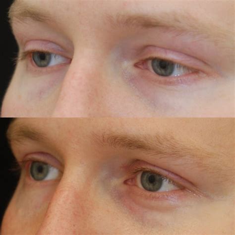 Eye Scar Tissue Removal Surgery Doctorvisit