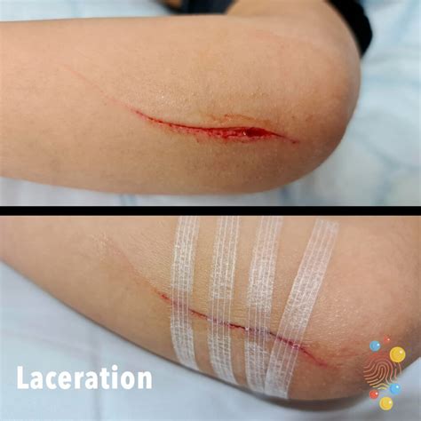 Laceration Wound