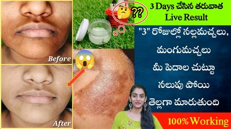 How To Remove Pigmentation Dark Patches Around Mouth🤔 Get Clear