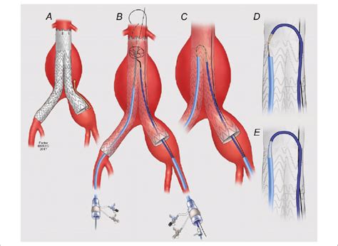 Internal Iliac Artery Aneurysm