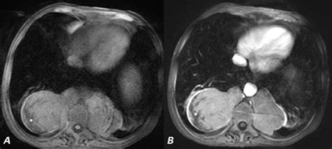 Chest Mri Pre A And Post Contrast B Fat Suppressed T1 Weighted