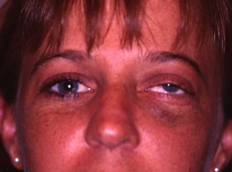 I got into a fight with someone picking on some kids and knocked the guy yes, like george, in the previous answer stated, fractures eventually heal. How long does a fractured eye socket take to heal ...