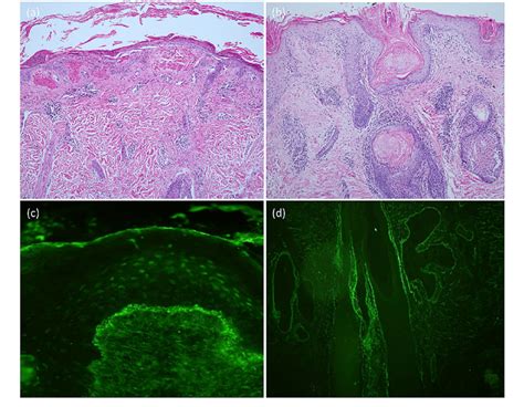 Histopathological And Direct Immunofluorescence Findings In Cutaneous