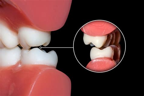 Bruxism Causes Reasons Why You Grind Your Teeth Peel Dental Studio