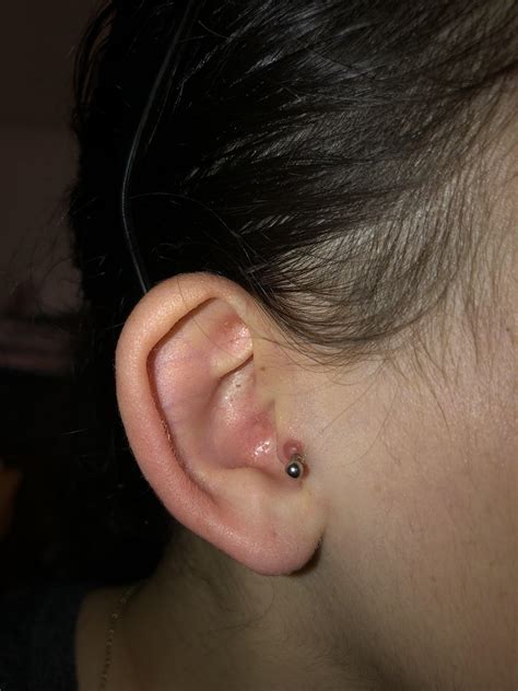 Keloid Tipstragus Jewelry Removal Tips Having A Hard Time With This One Rpiercing