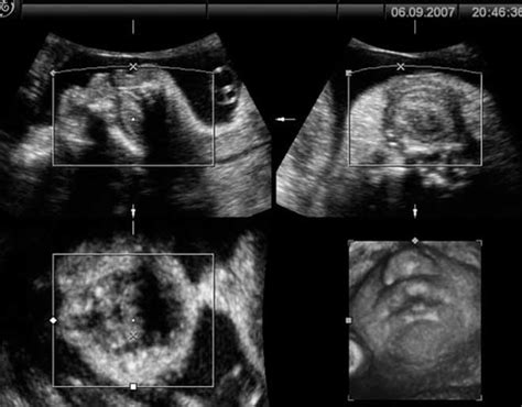 Three‐dimensional Ultrasound Diagnosis Of Cleft Palate ‘reverse Face