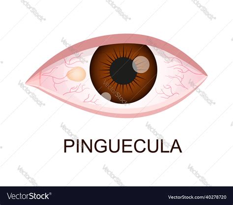 Pinguecula Conjunctival Degeneration Eye Disease Vector Image