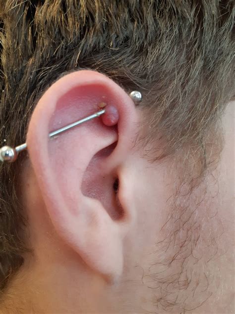 Keloid Scar From Ear Piercing Healed By Nourisil Md Scar Treatment