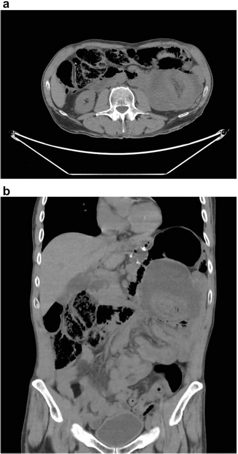 Thoracoabdominal Computed Tomography Identifying Intussusception Of A