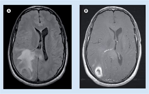 Neuroimaging Of Epilepsy A Review Of Mri Findings In Uncommon