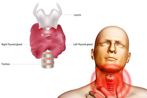 Thyroid Pain Hyperthyroidism And Hypothyroidism