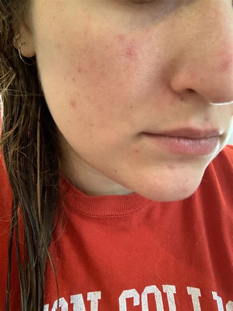[skin concern] cheek bumps redness r skincareaddiction