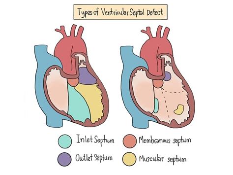 Patofisiologi Ventricular Septal Defect Alomedika The Best Porn Website