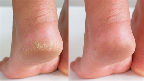 7 Foot Treatments That May Heal Dry And Cracked Skin For Good