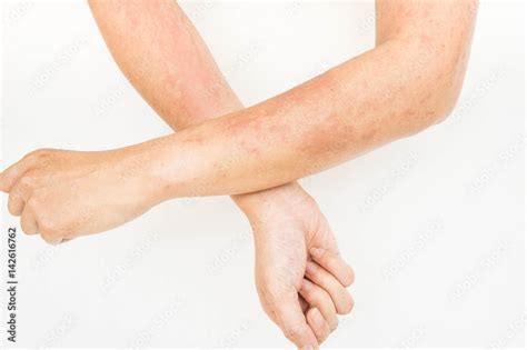 Skin Rashes Allergies Contact Dermatitis Allergic To Chemicals