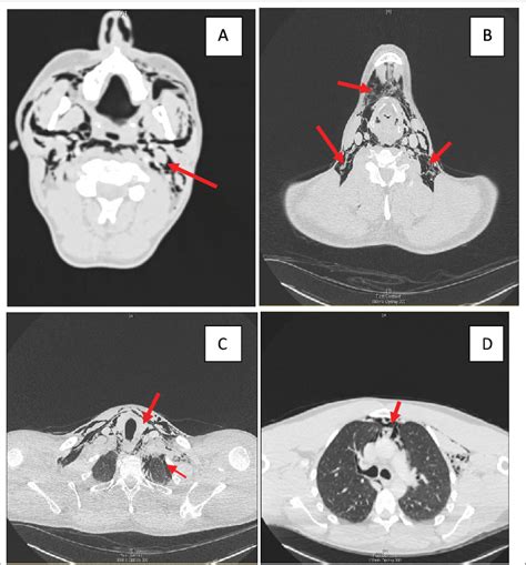 Ct Neck And Chest With Contrast A And B Extensive Bilateral Surgical