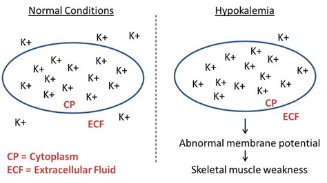 What Is Hypokalemia Definition Causes Symptoms And Treatment