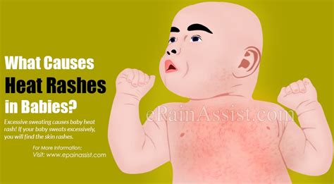 What Causes Baby Heat Rash And What Is Its Treatment Prevention