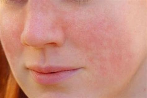 Lupus Rash On Face
