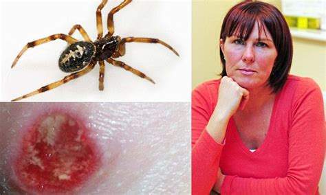 Nurse In Agony After She Was Bitten By False Widow Spider Daily Mail Online
