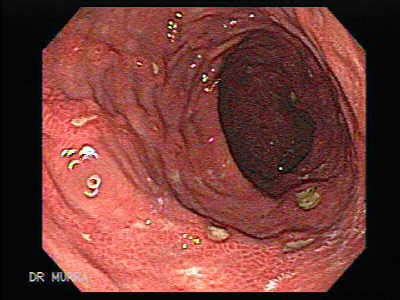 Duodenal Ulcer Endoscopy