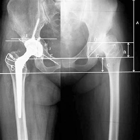 the radiographic measurements included a pelvic height b height of download scientific